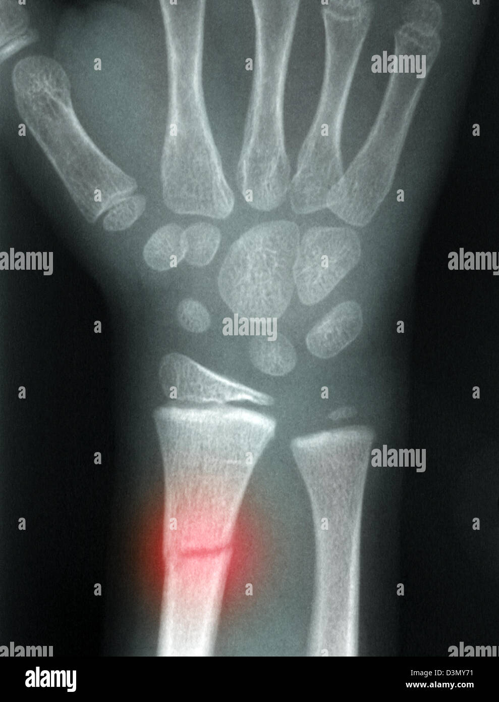 X-ray montrant une fracture du radius distal chez un enfant Banque D'Images