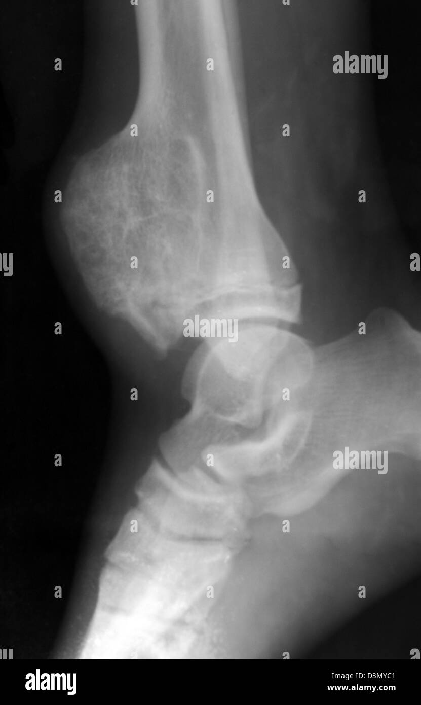 X-ray montrant une tumeur de l'extrémité distale du tibia Banque D'Images