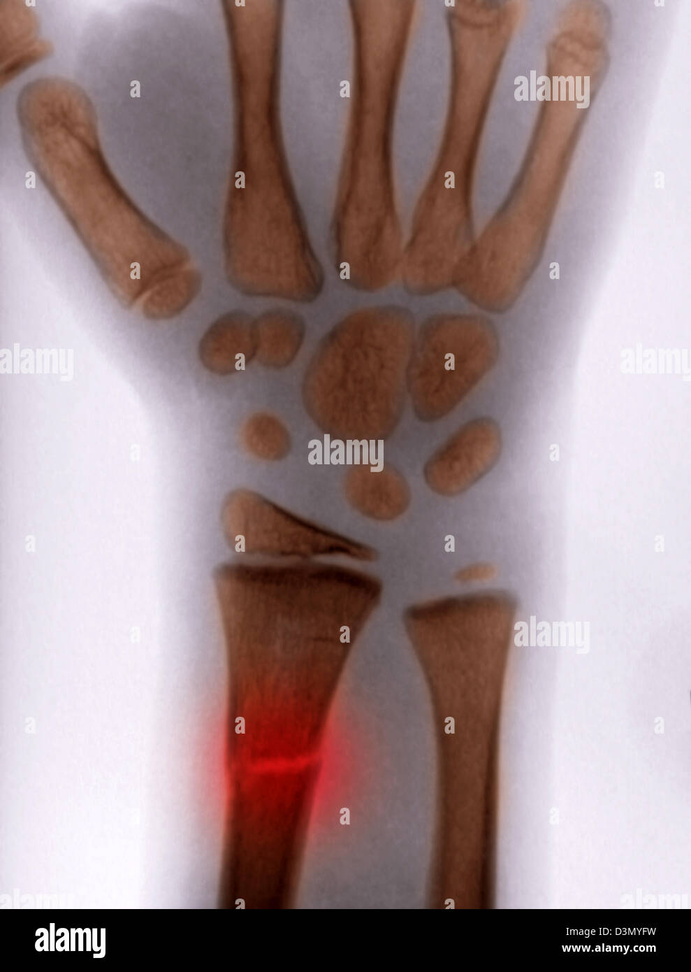 X-ray montrant une fracture du radius distal chez un enfant Banque D'Images