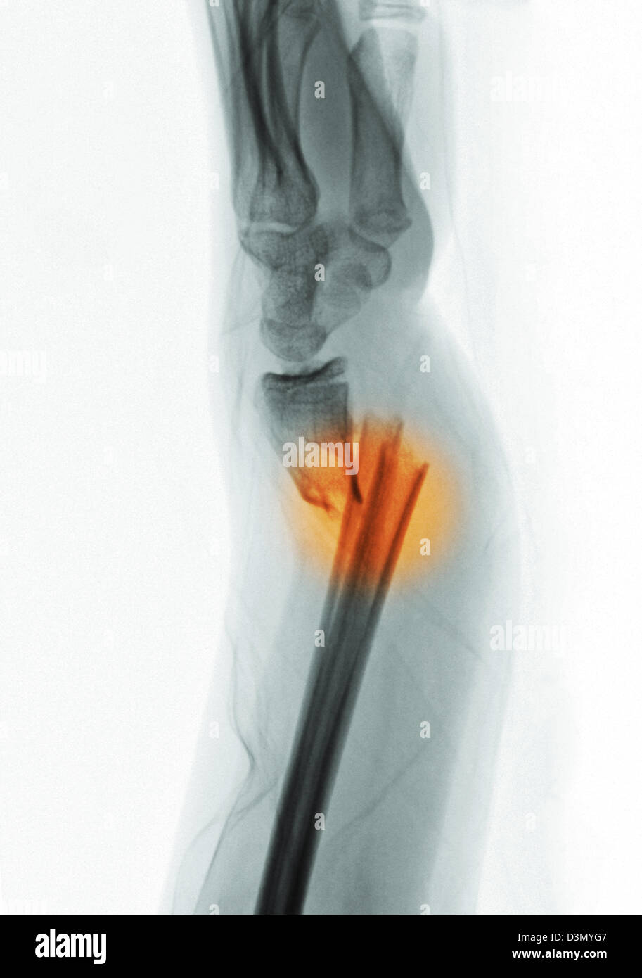 X-ray montrant une fracture de la partie distale du radius et cubitus dans une jeune fille de 12 ans Banque D'Images