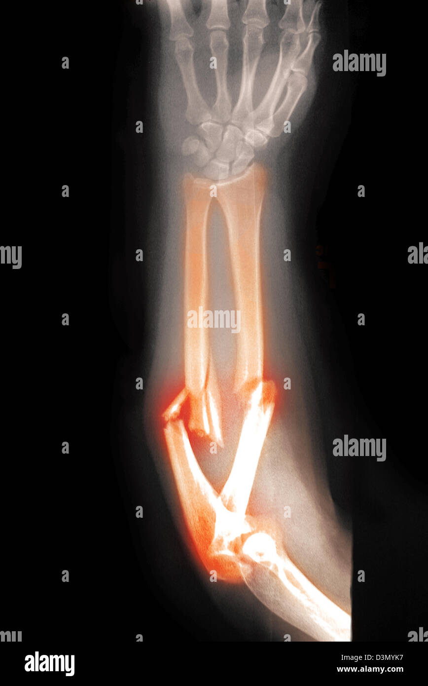 Fracture de l'avant bras Banque de photographies et d’images à haute