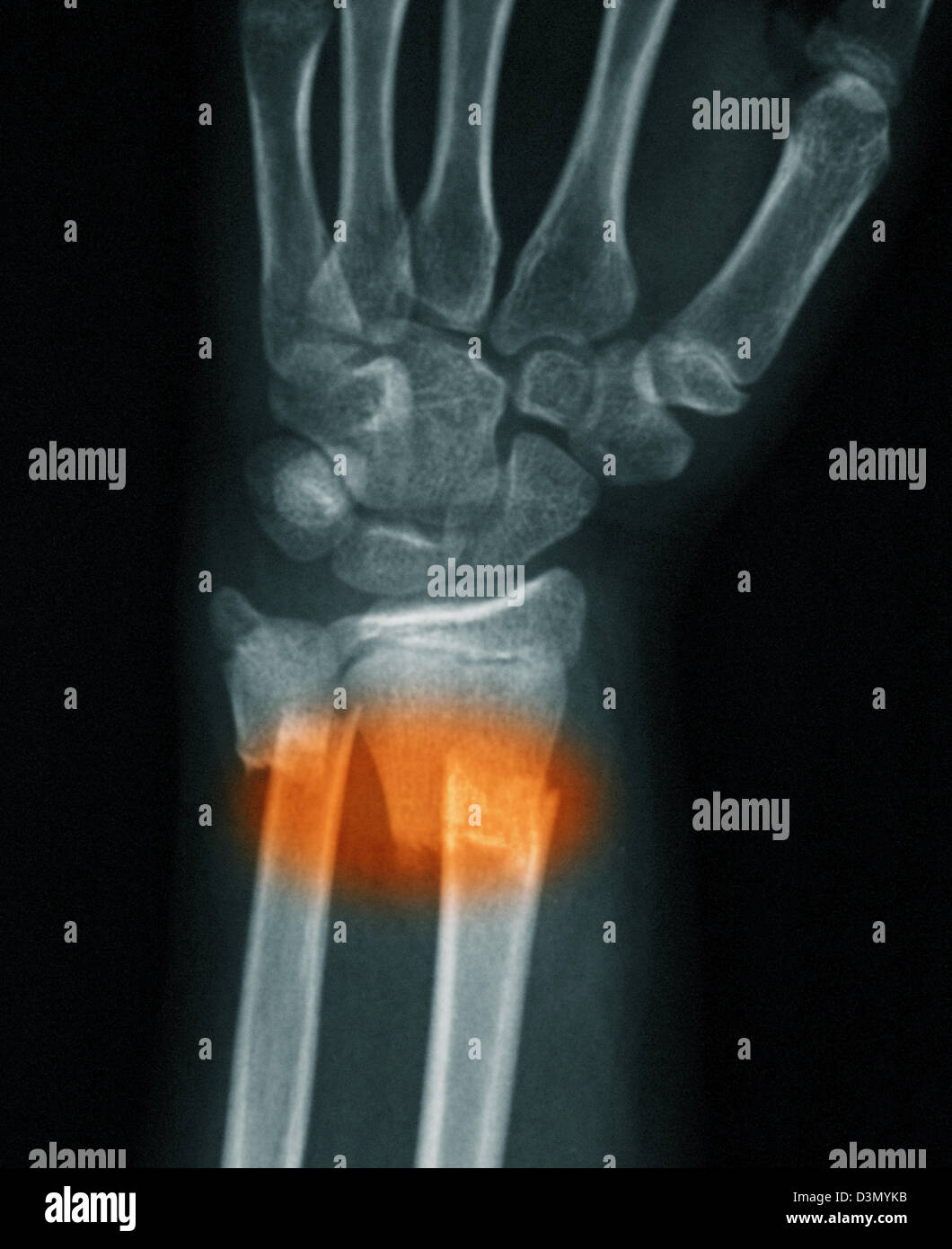 X-ray montrant une fracture de la partie distale du radius et cubitus dans une jeune fille de 12 ans Banque D'Images