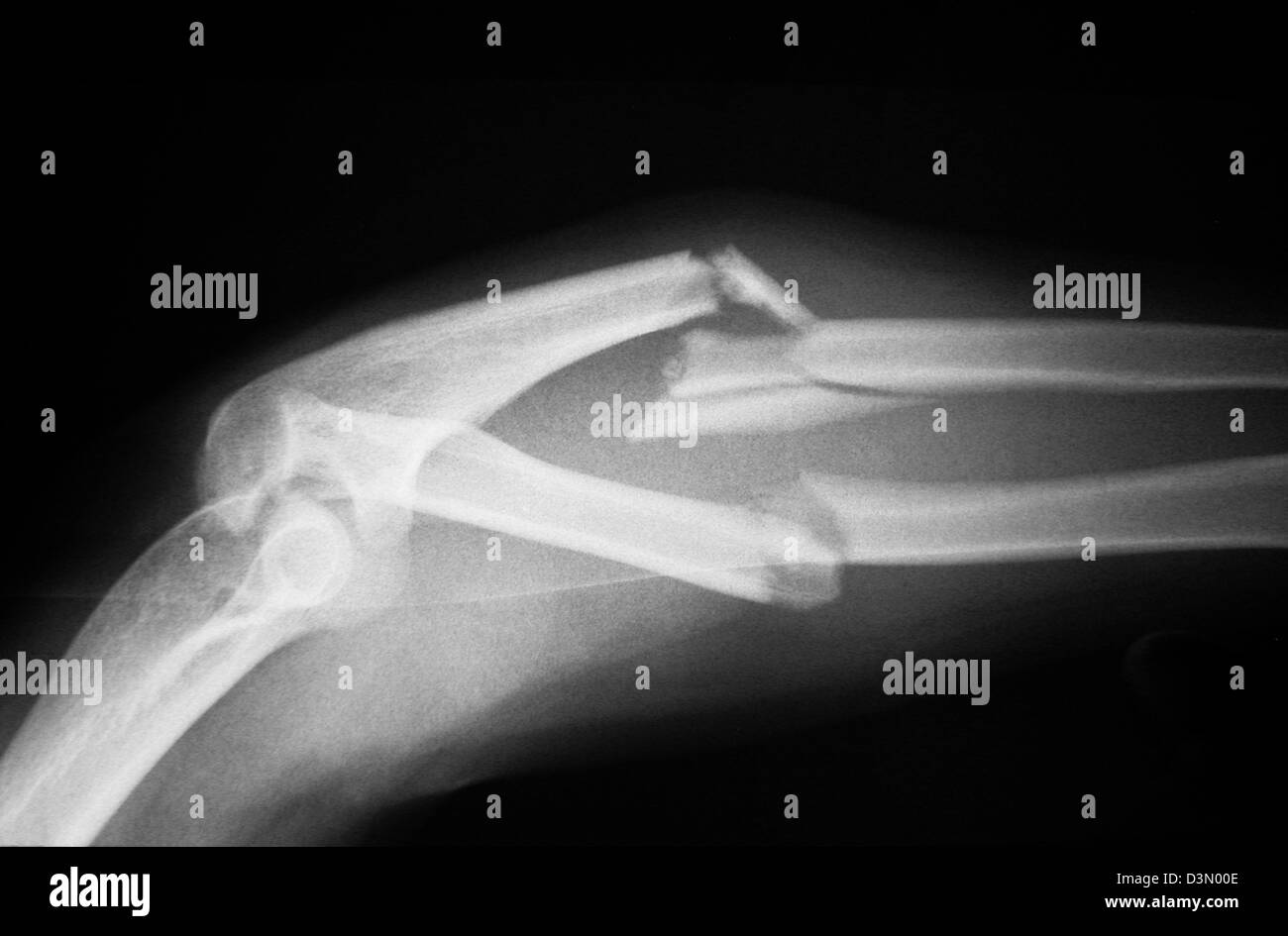 X-ray montrant une fracture comminutive et fortement inclinée de l'avant-bras Banque D'Images