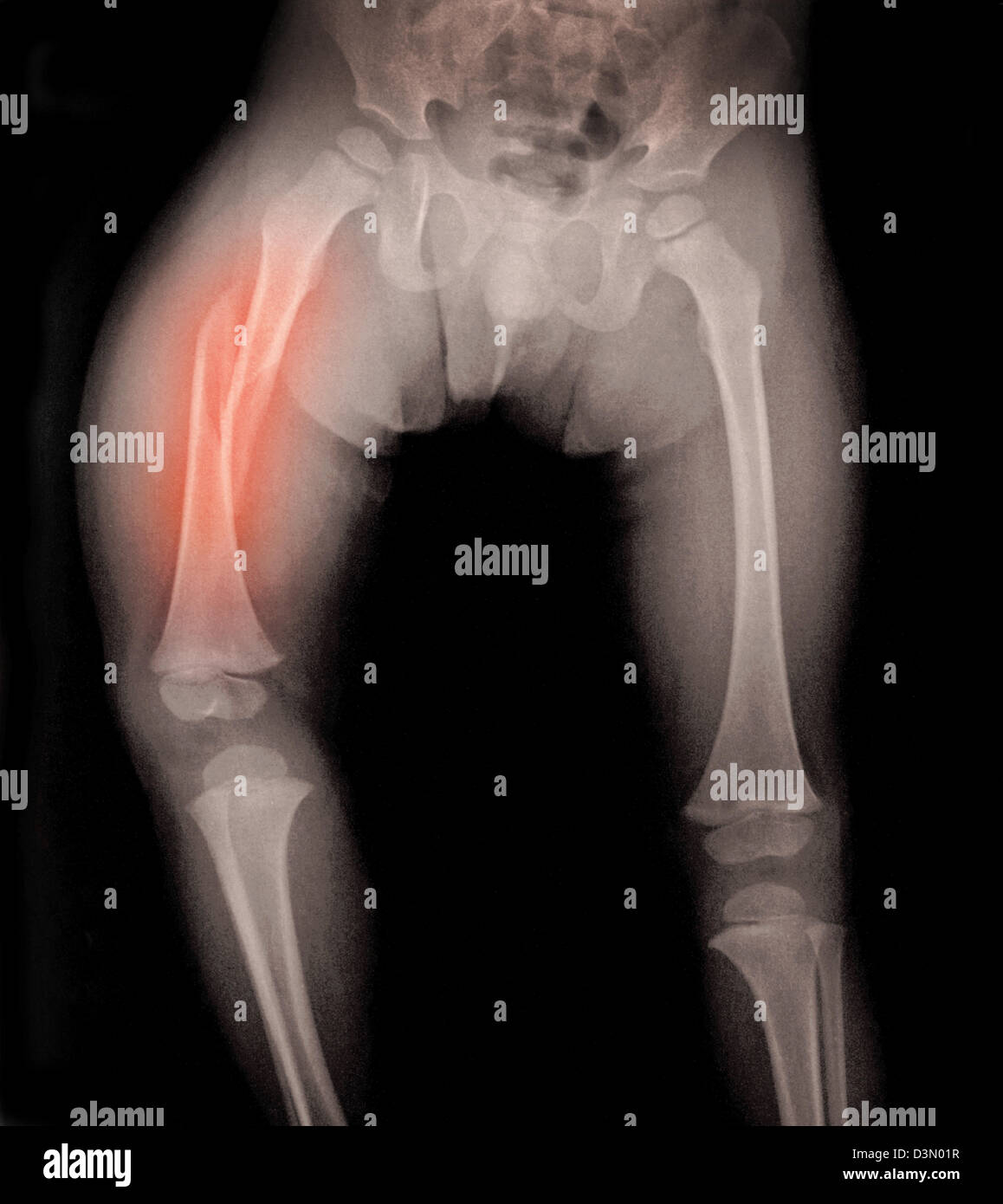 X-ray montrant une fracture du fémur dans un enfant, un enfant victime de violence Banque D'Images
