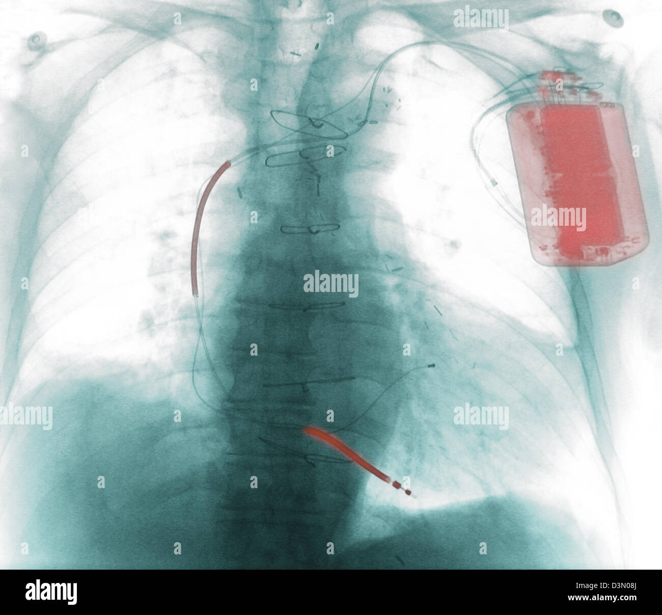 Radiographie montrant un défibrillateur implanté Banque D'Images