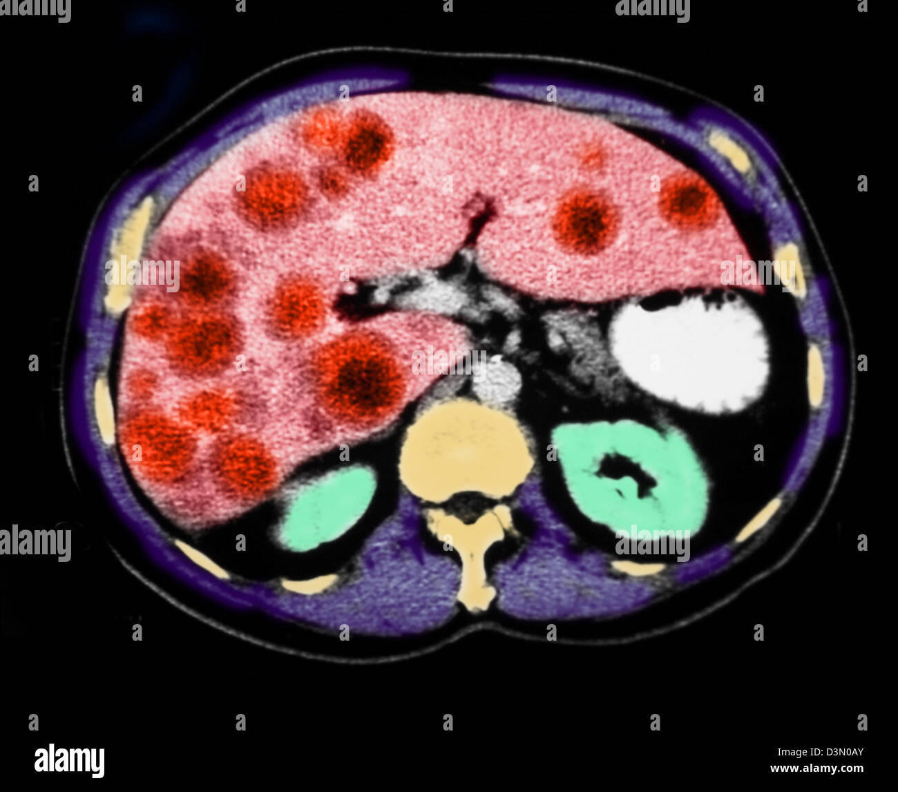 Des coupes scanner montrant un cancer du foie métastatique Banque D'Images