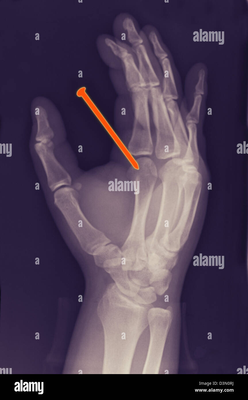 Hand x-ray of a 26 year old man qui accidentellement tiré sur un clou d'une cloueuse à travers sa main Banque D'Images