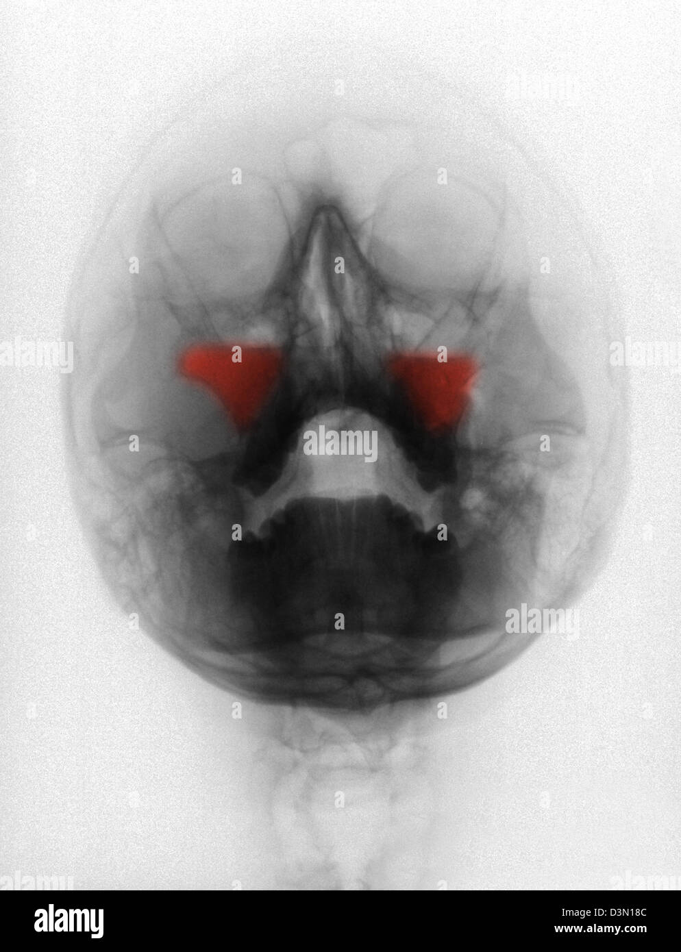 Skull x-ray montrant les fractures du sinus maxillaire bilatéral Banque D'Images