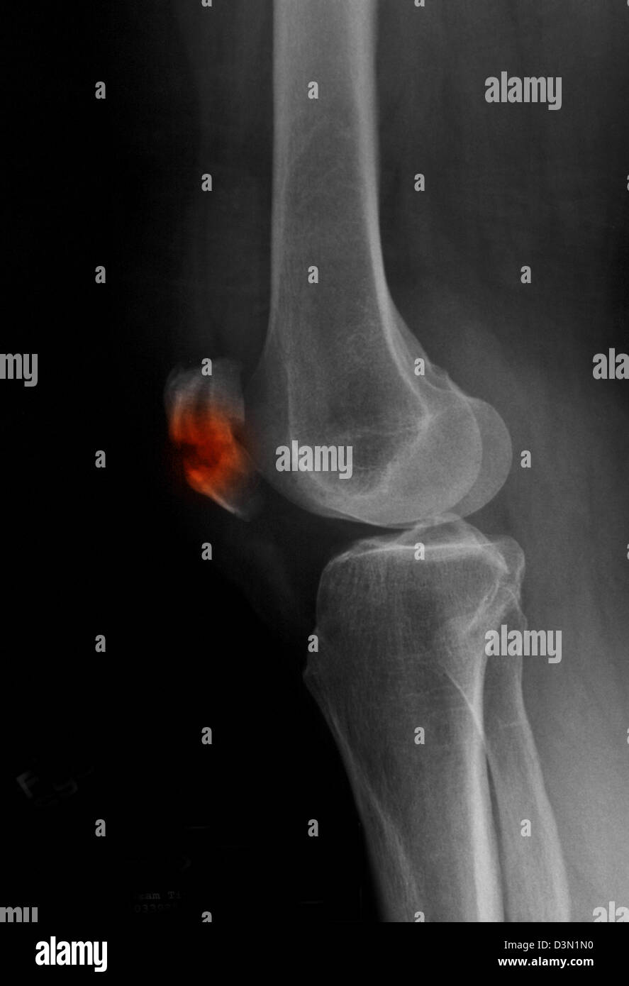 Xray montrant une fracture de la rotule, rotule Photo Stock Alamy