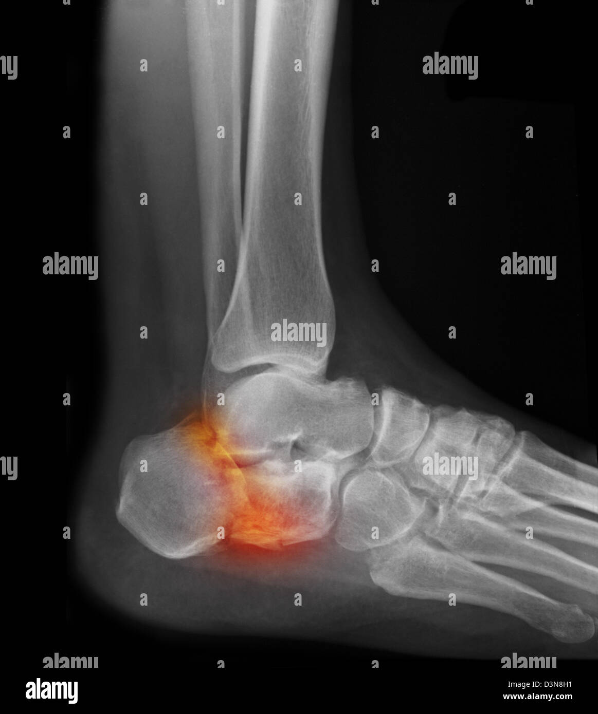 Radiographie d'un pied d'homme montrant une fracture du talon Photo Stock -  Alamy