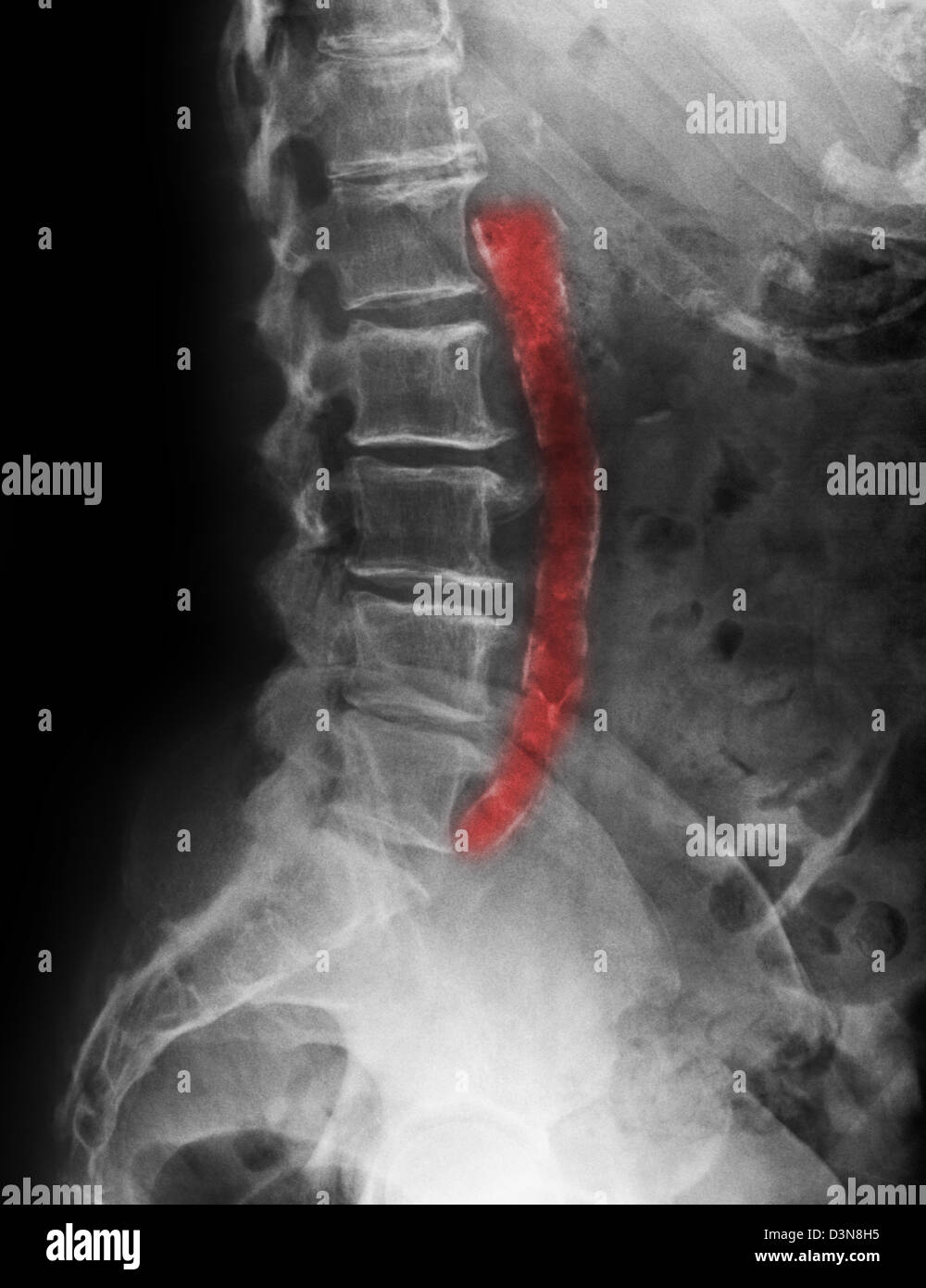X-ray d'une femme de 81 ans montrant une aorte calcifiée de la maladie artérielle athéromateuse Banque D'Images