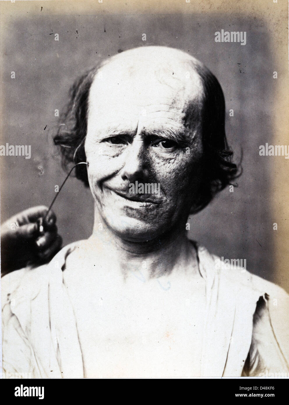 Duchenne de boulogne Banque de photographies et d’images à haute ...