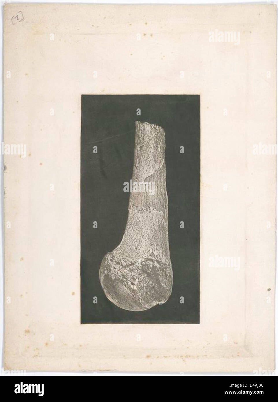 Un mémoire chirurgical de la guerre de Sécession, mettant en évidence une lésion osseuse et une nécrose chez un soldat. Cette image fait partie des archives de la Commission sanitaire des États-Unis, documentant les pratiques médicales pendant la guerre de Sécession. Banque D'Images