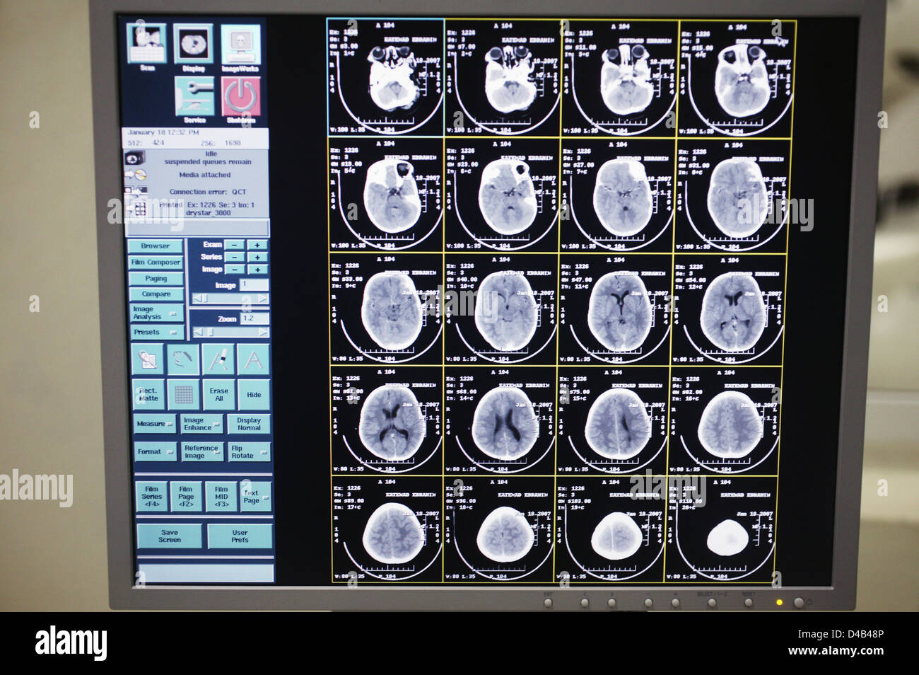 Image de CT scan du cerveau de l'enfant de 5 ans souffrant de fibrose kystique Banque D'Images