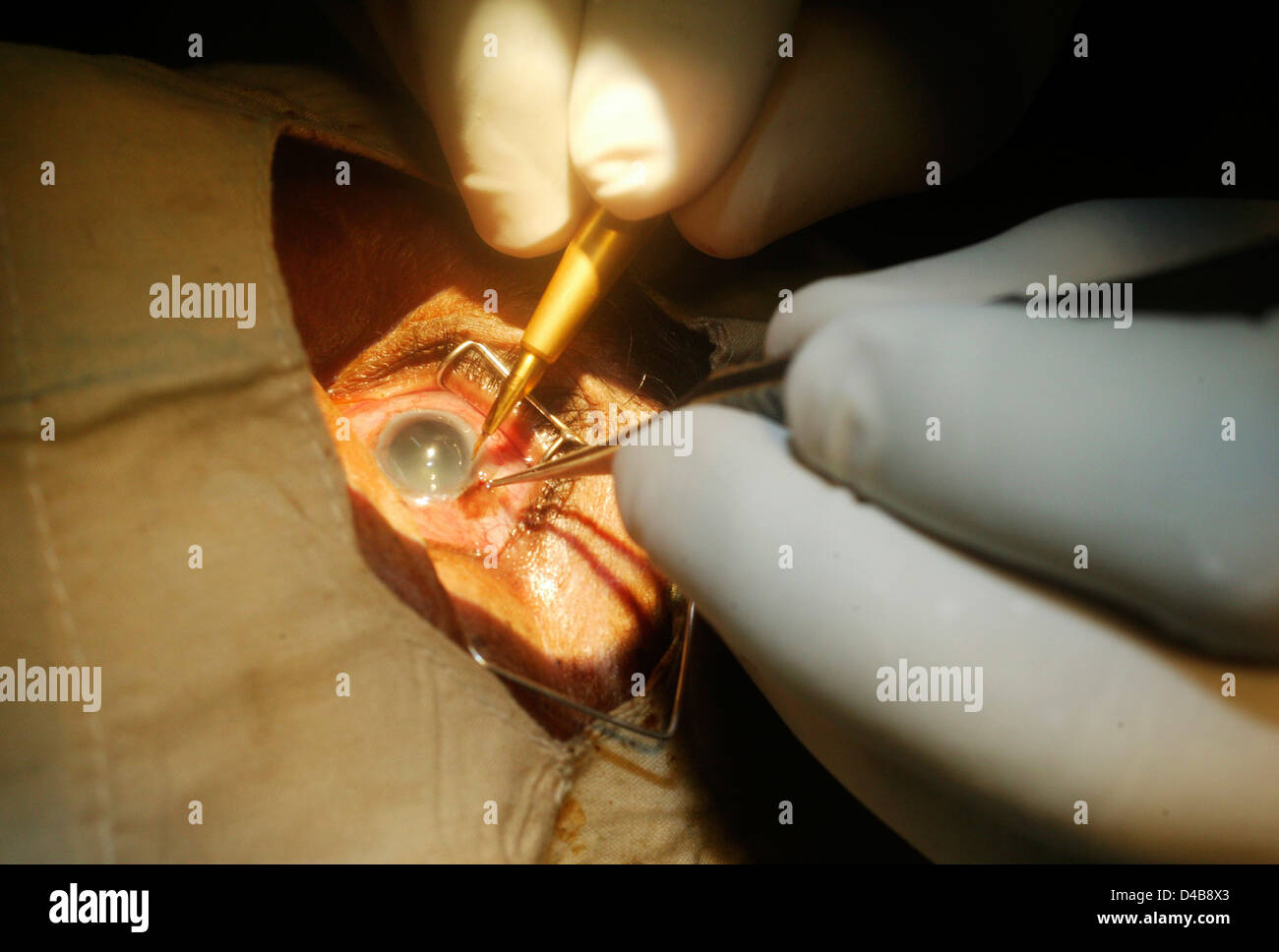 Close up de la cataracte chirurgiens créer incision initiale en limbe (où se réunit la Cornée Sclère) de l'utilisation du scalpel il forme de petites Banque D'Images
