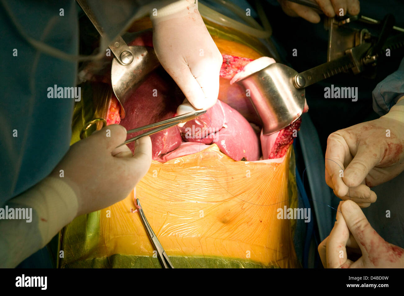Chirurgiens d'effectuer une greffe du foie au Samsung Medical Center. Banque D'Images