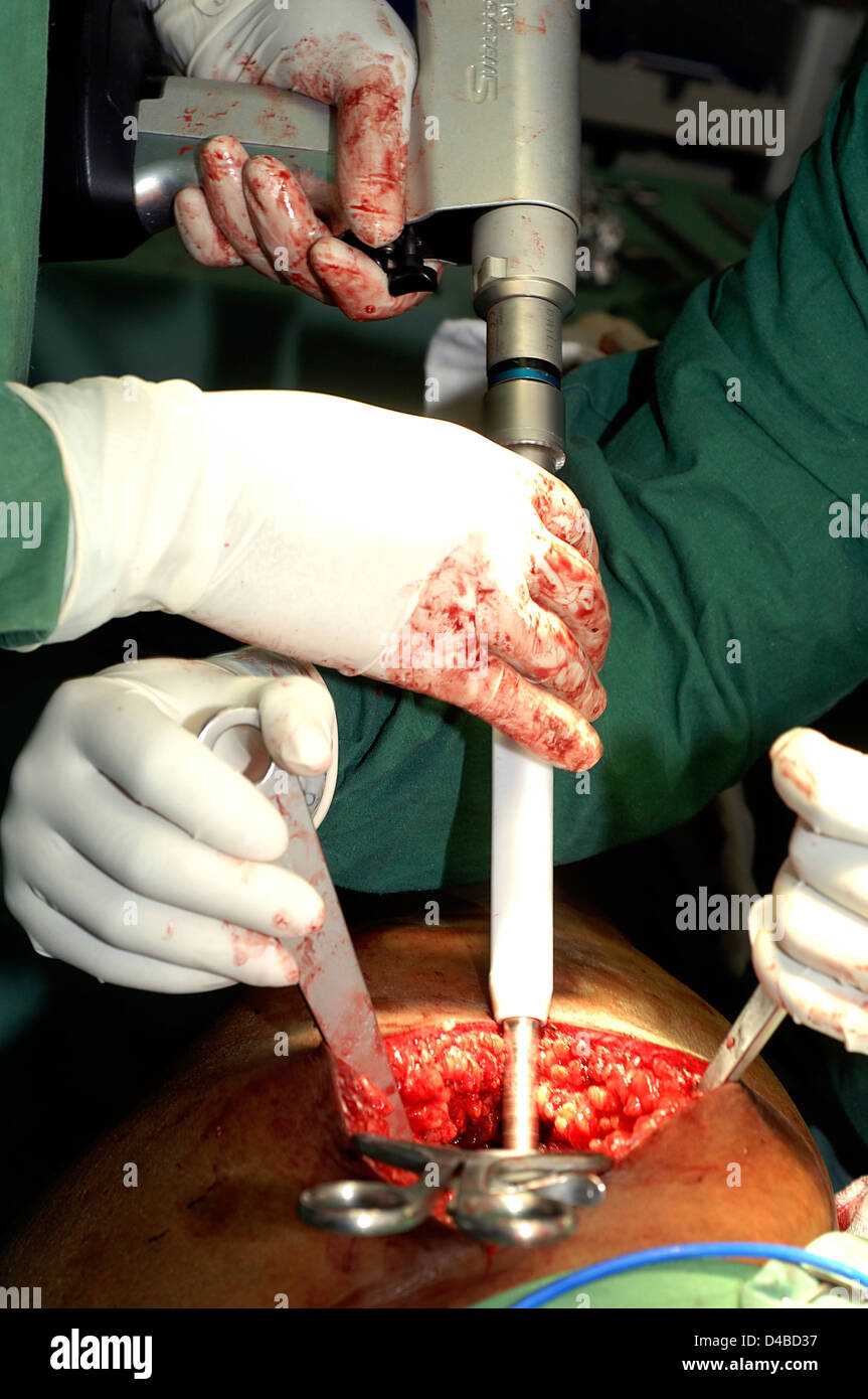 Les chirurgiens de la hanche poche utilisation enrouleurs Hohmann éviter tissus environnants s'effondrer sur l'obstruction de l'aléseur Banque D'Images