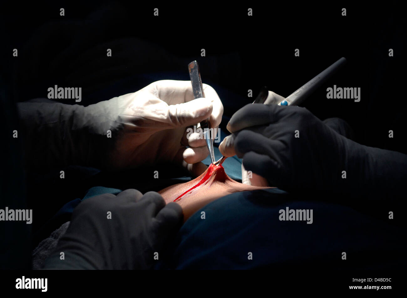 Le chirurgien d'effectuer l'opération pour retirer une partie de l'intestin du patient. Le Soudan, l'Afrique. Banque D'Images