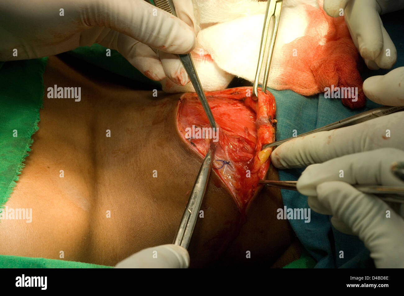 La thyroïdectomie. Pinces d'Allis est adjoint de la peau tout en rétraction chirurgien prépare d'subcutaenous bords tissu lâche blessure. Banque D'Images