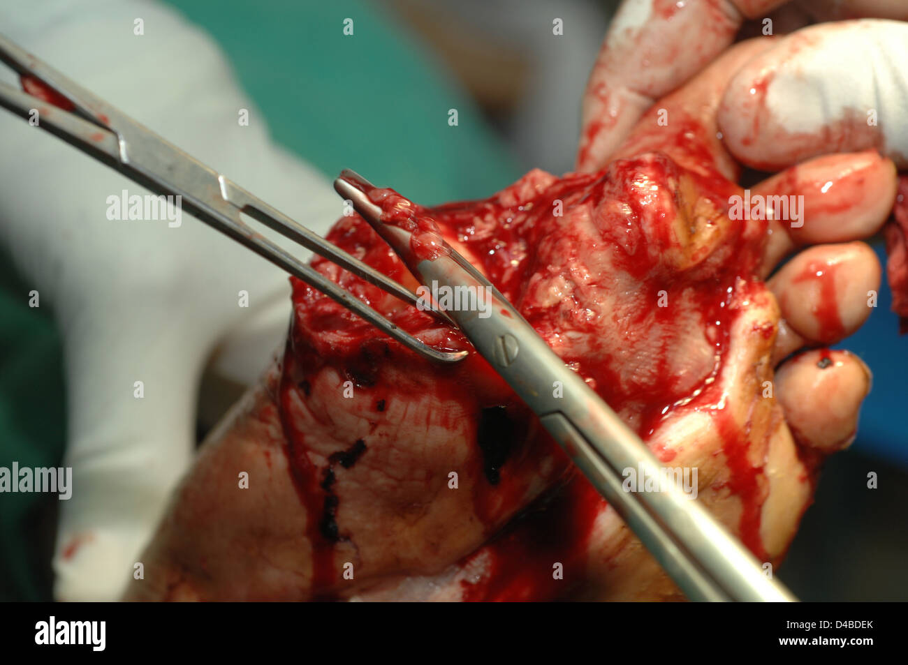 Pied a eu une destruction massive des tissus humains en raison de l'infection bactérienne diabétiques plus susceptibles des infections bactériennes comme Banque D'Images
