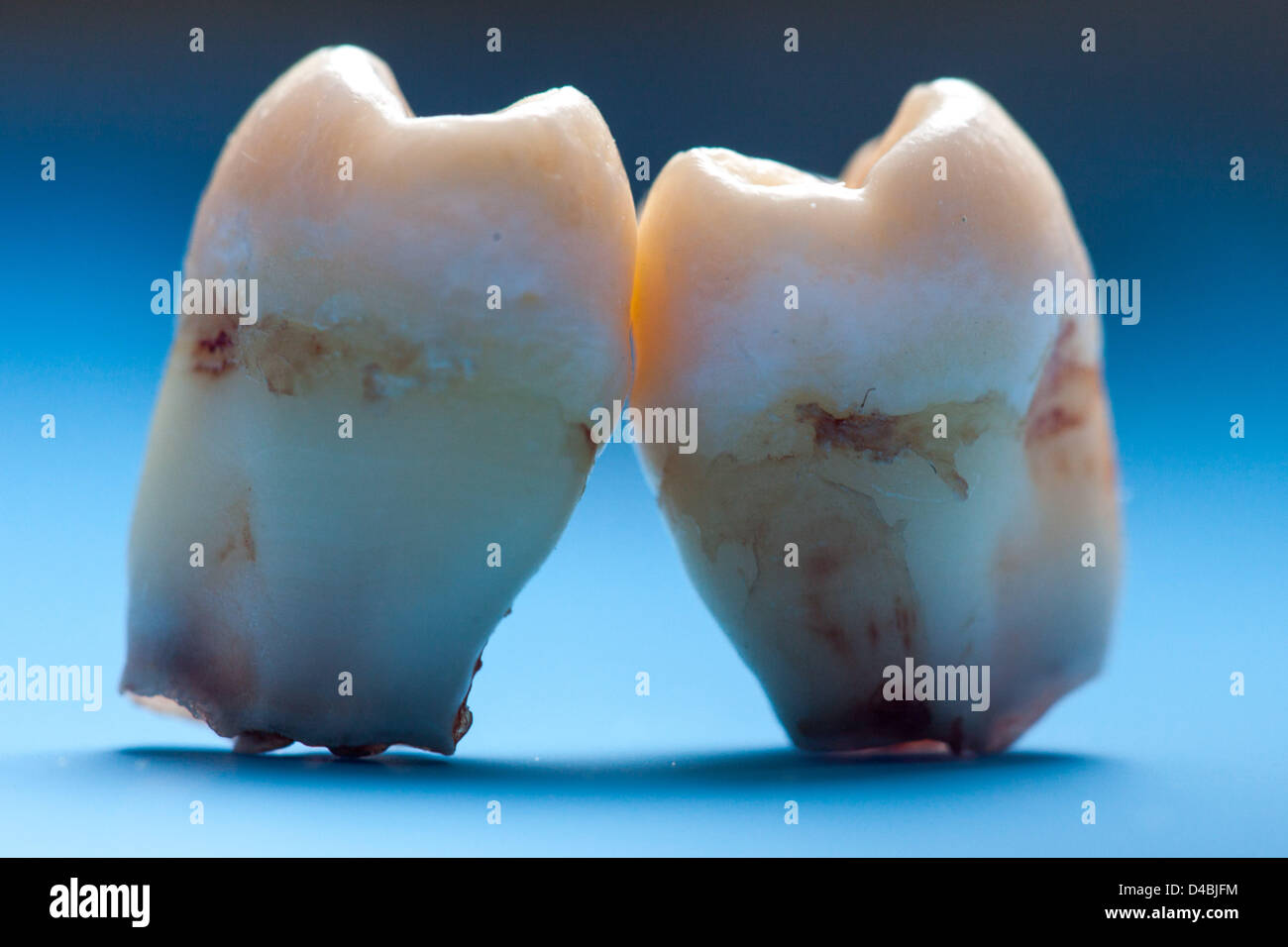 Nettoyer les dents de sagesse, extraction pas pleinement développées. Banque D'Images