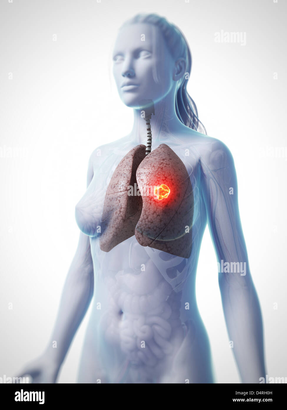 Le cancer du poumon en surbrillance Banque D'Images