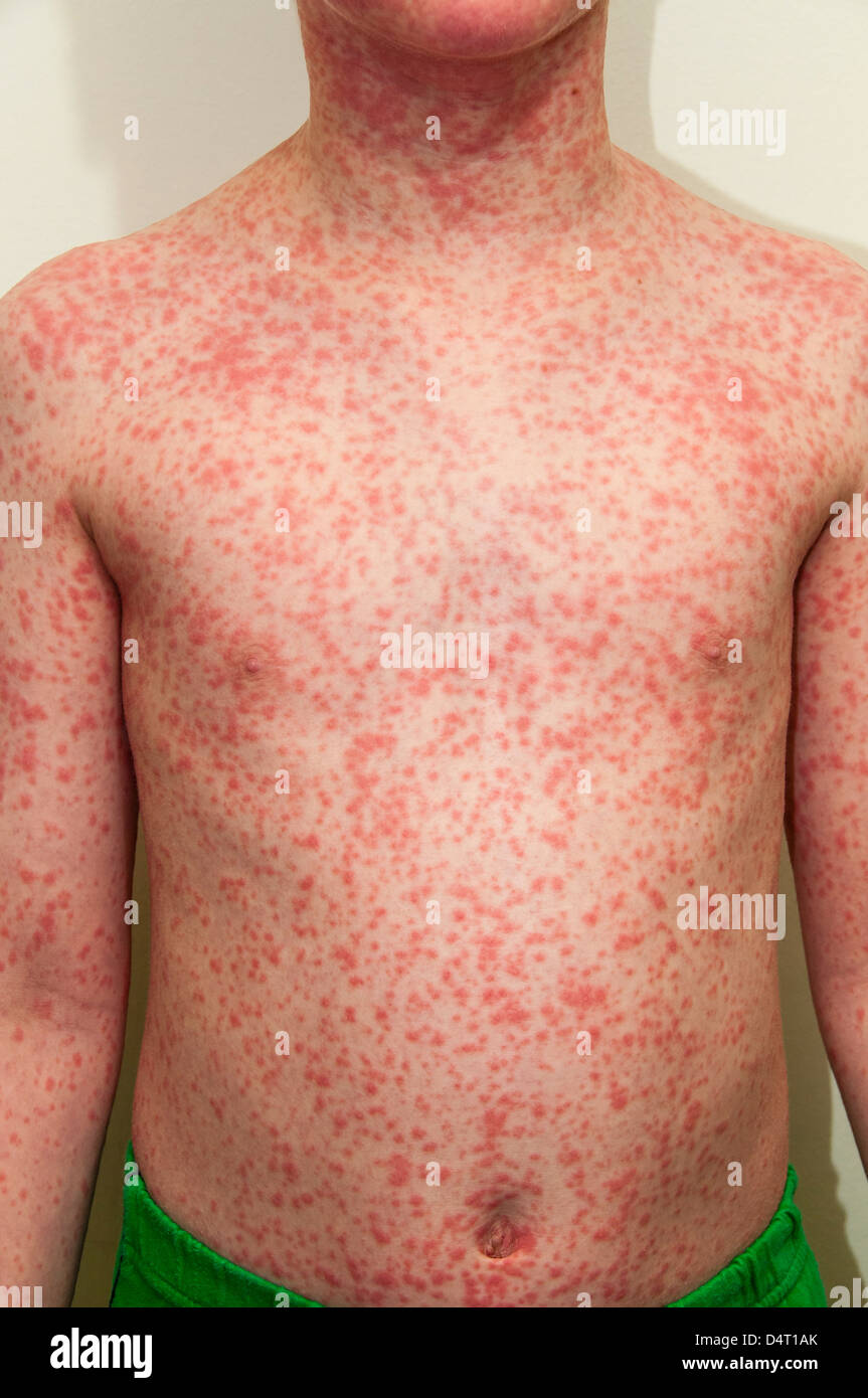 Eruption Allergique Banque D Image Et Photos Alamy