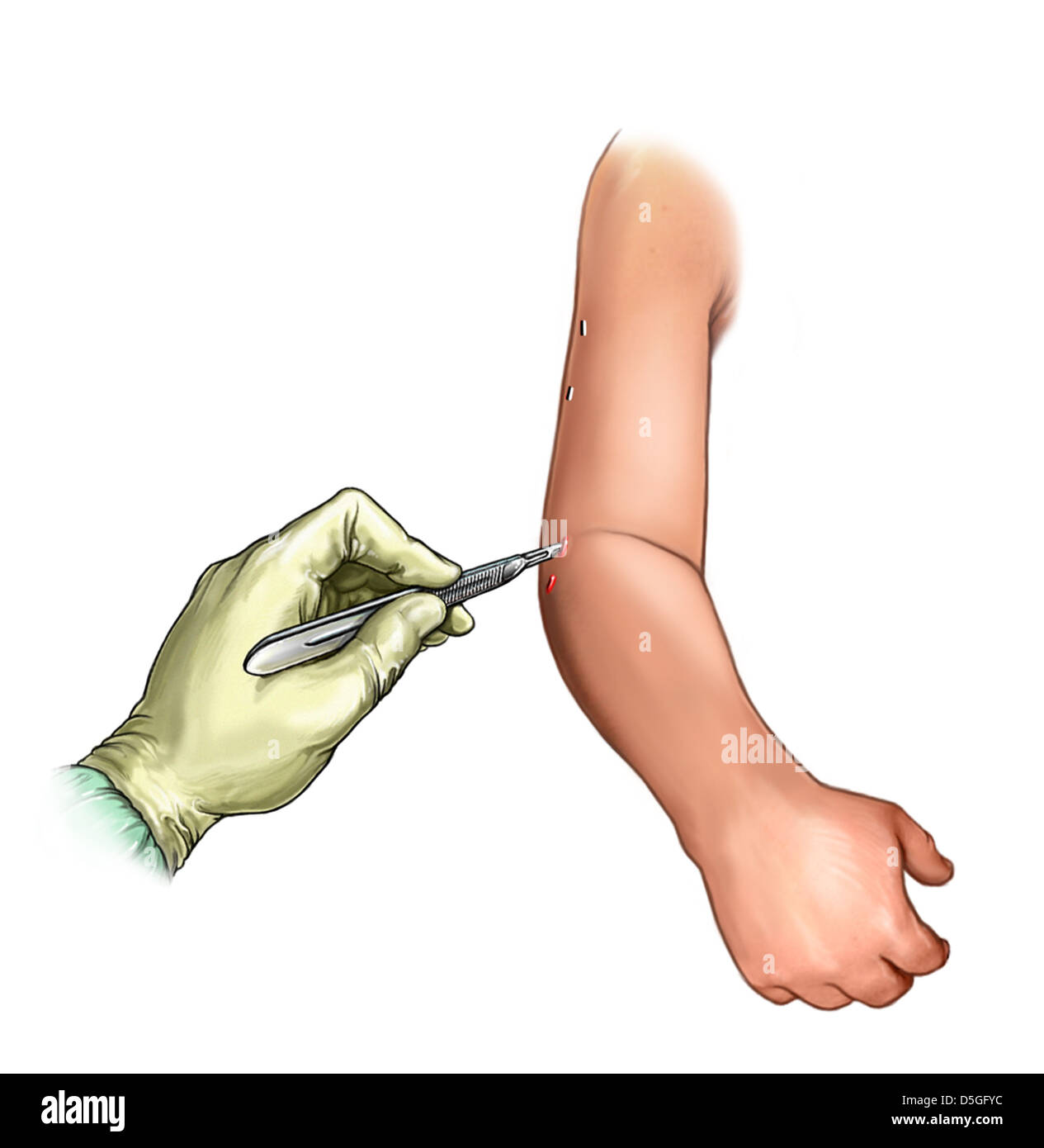 Arm-stab fixateur externe d'incisions Photo Stock - Alamy