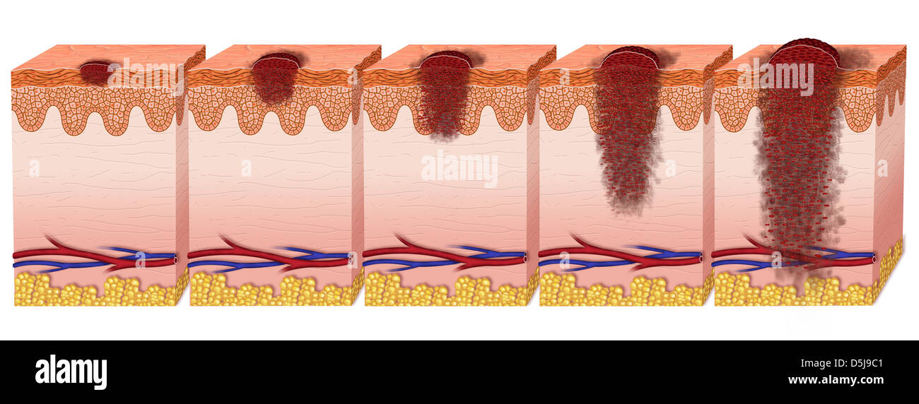Étapes et l'évolution d'un mélanome de la peau Photo Stock - Alamy