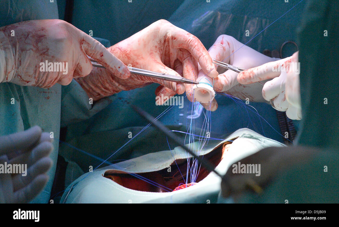Chirurgien cardiaque met une nouvelle pompe sanguine mécanique dans la poitrine du patient à l'Institut de médecine clinique et expérimentale (IKEM) à Prague, République tchèque, le 3 avril 2013. IKEM fête ses dix ans à l'aide de cette méthode. (Photo/CTK Michal Dolezal) Banque D'Images