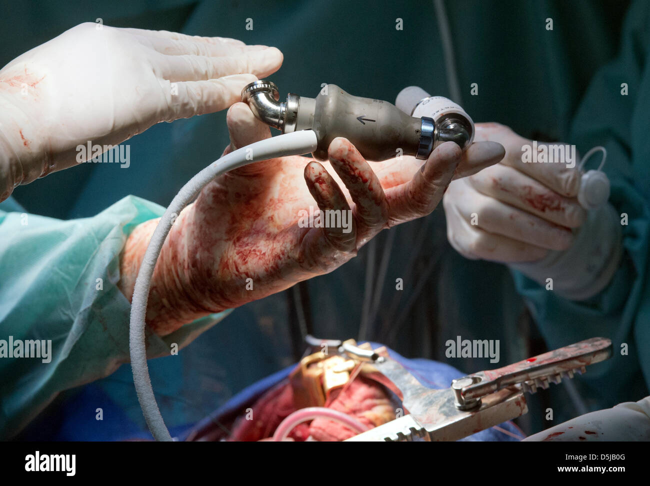 Chirurgien cardiaque met une nouvelle pompe sanguine mécanique dans la poitrine du patient à l'Institut de médecine clinique et expérimentale (IKEM) à Prague, République tchèque, le 3 avril 2013. IKEM fête ses dix ans à l'aide de cette méthode. (Photo/CTK Michal Dolezal) Banque D'Images