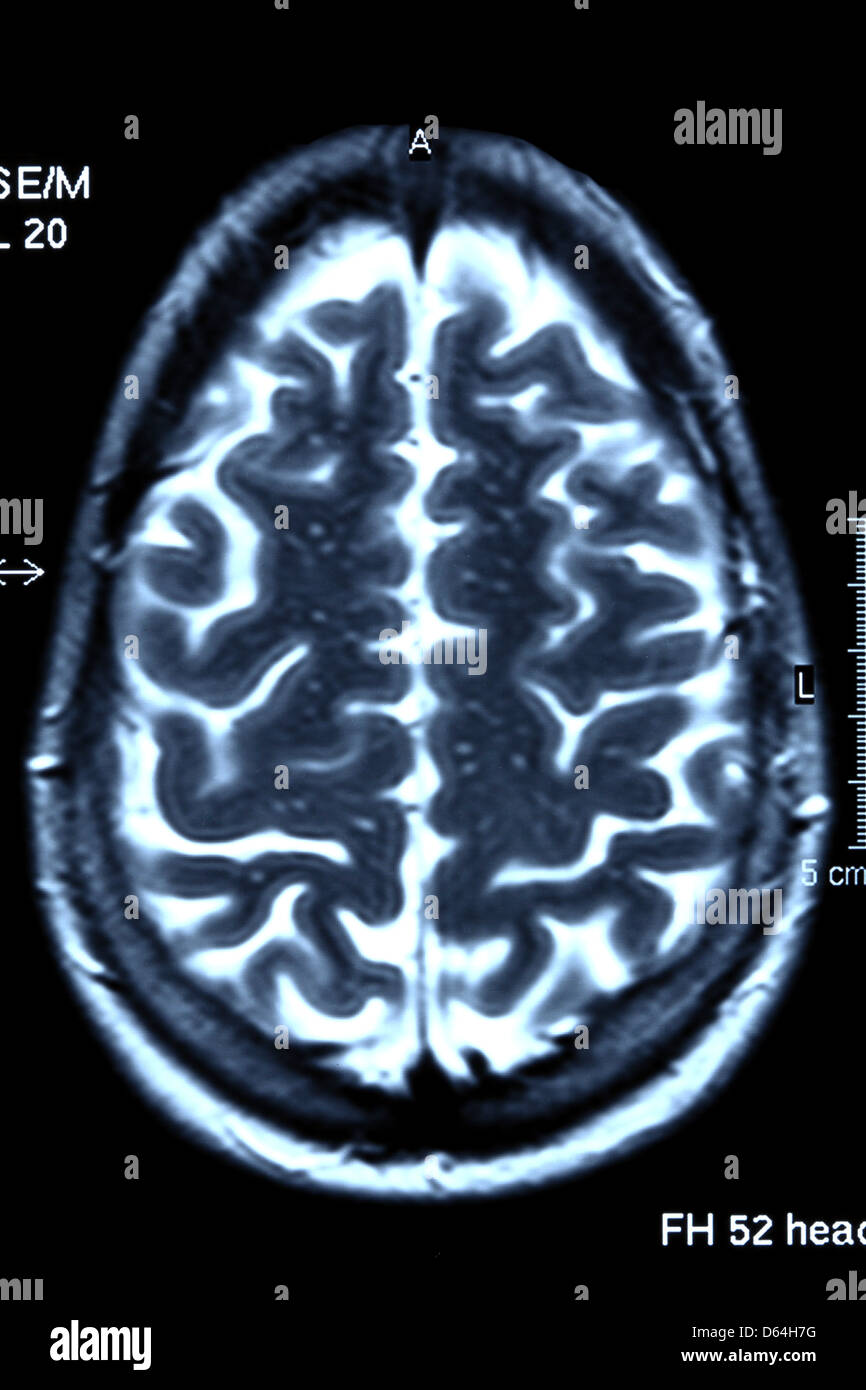 Analyse par résonance magnétique du cerveau. L'IRM scanner de la ...