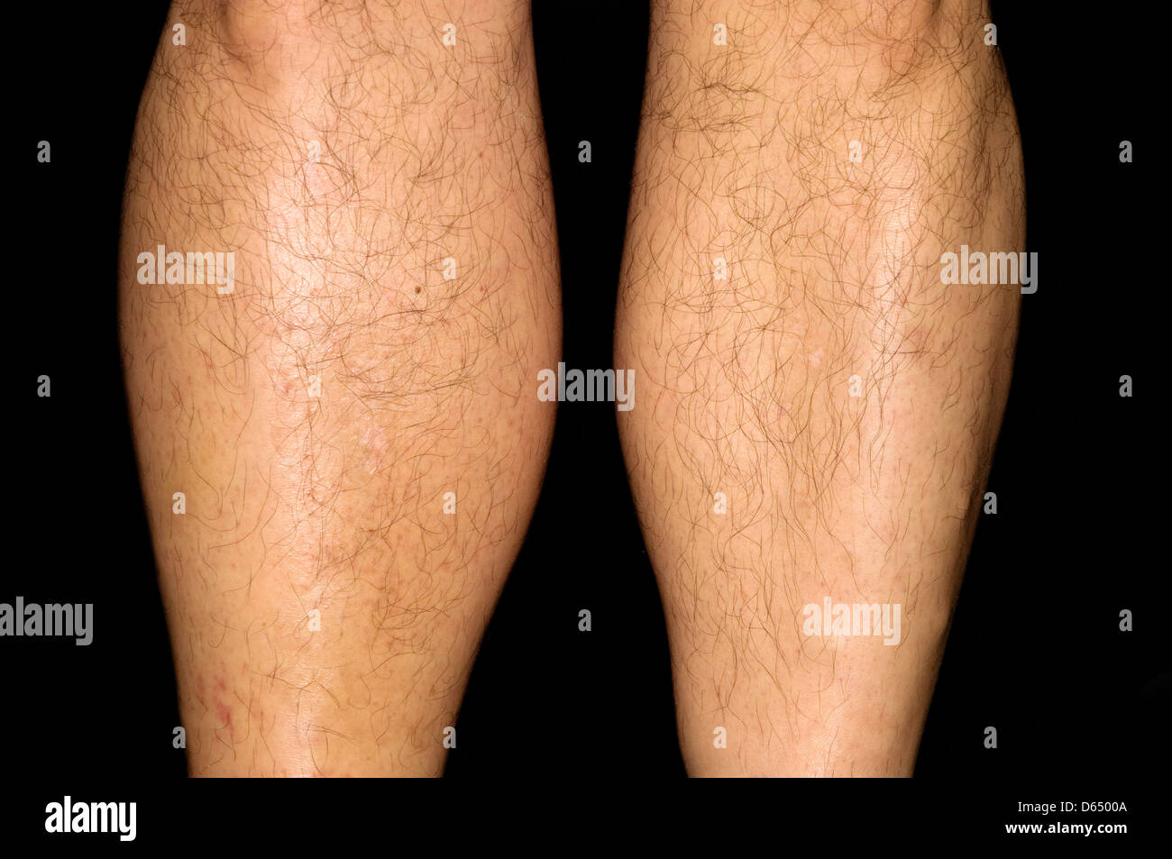 La thrombose profonde de veine Banque D'Images