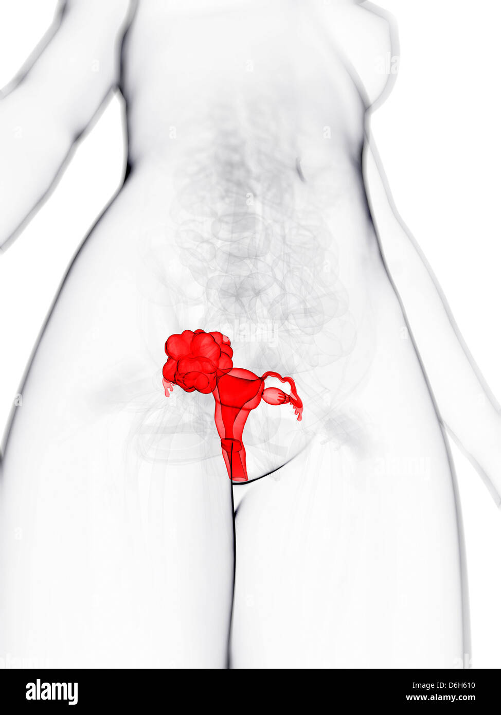Cancer de l'utérus, artwork Banque D'Images
