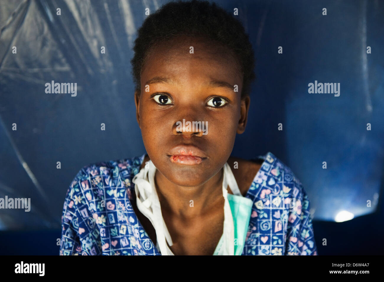 Victime du VIH, de la tuberculose du patient de l'hôpital après le tremblement de terre de janvier 2010, l'hôpital général, de Port-au-Prince, Haïti, Caraïbes Banque D'Images