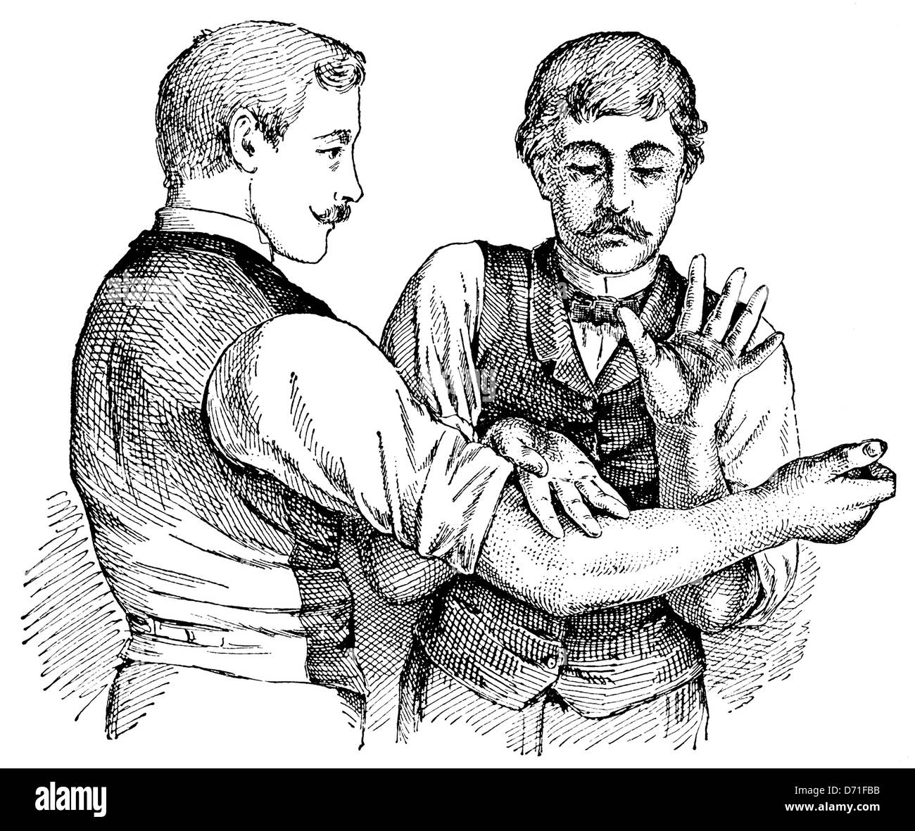 Technique de massage tapotement, les techniques thérapeutiques au début du 20e siècle, illustration Banque D'Images