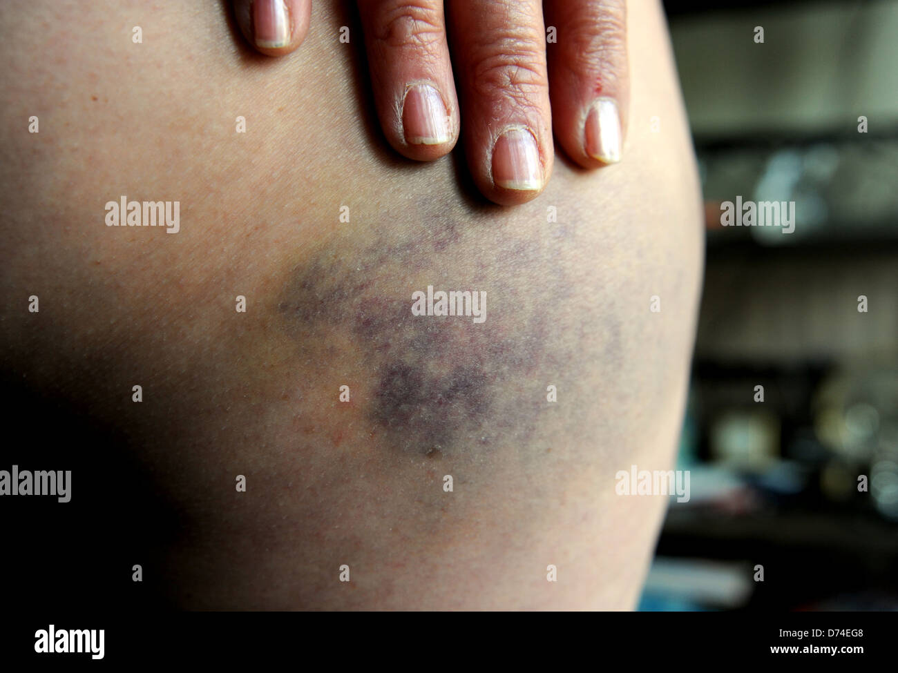 Montre Femme avec des blessures à la peau d'ecchymoses sur la cuisse de la jambe après une chute Banque D'Images