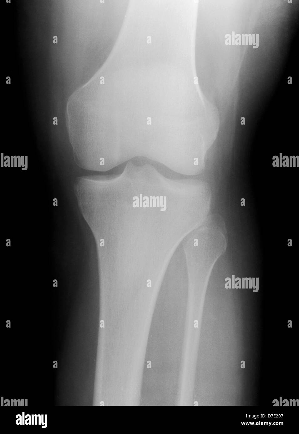 Radiographie d'un genou humain Banque D'Images