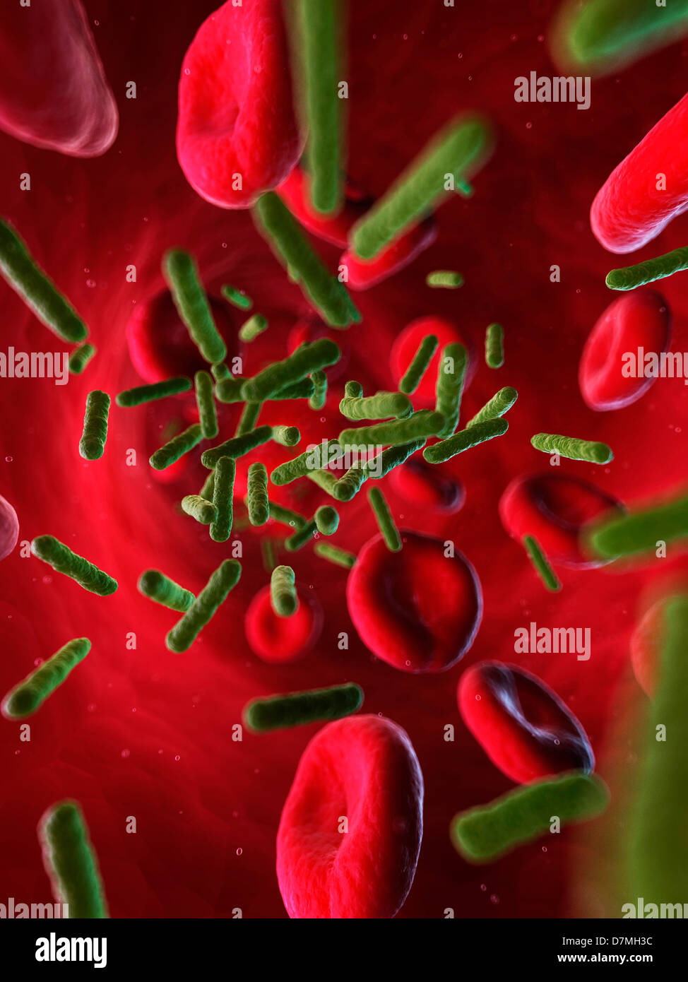 L'infection bactérienne, artwork Banque D'Images