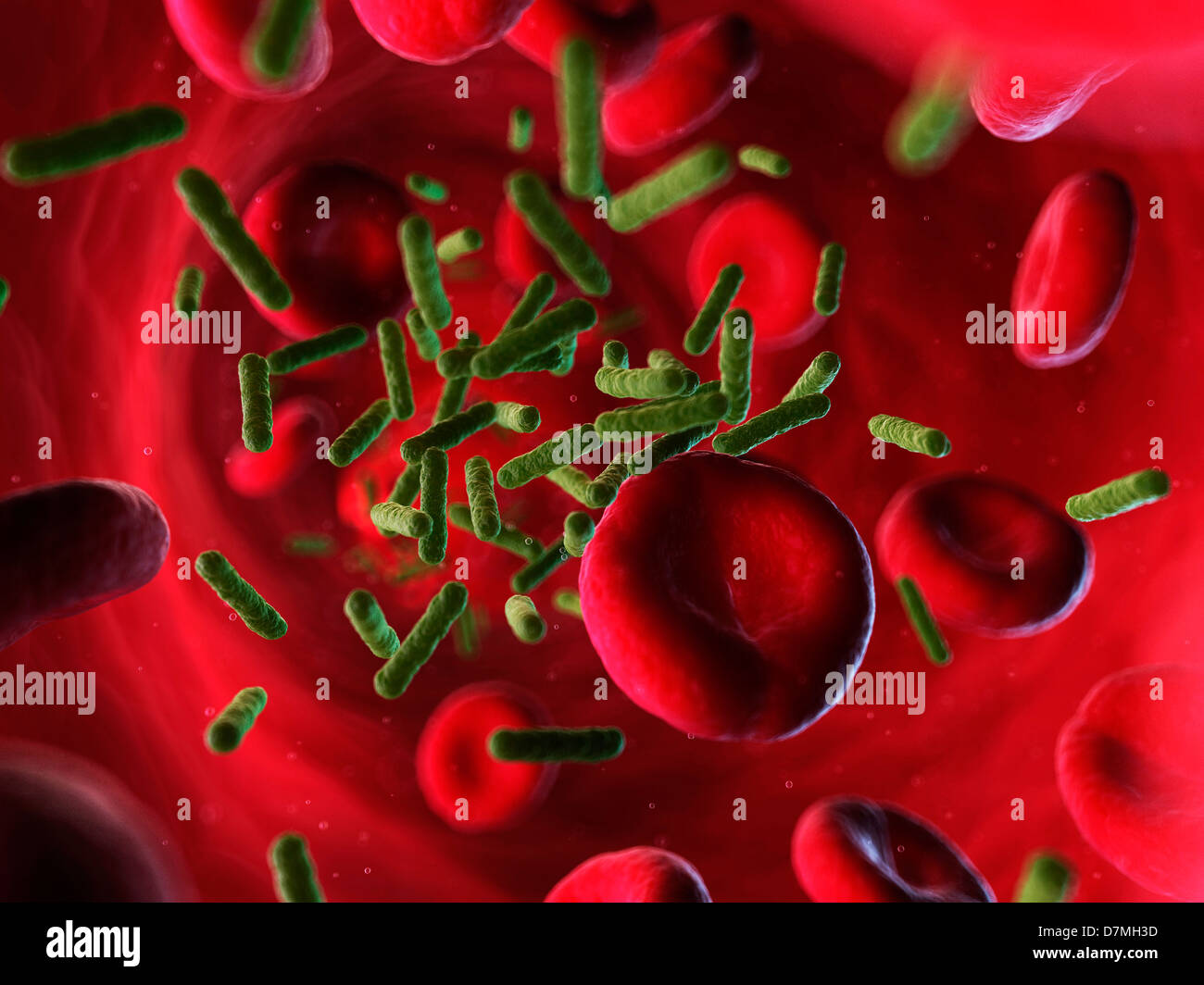 L'infection bactérienne, artwork Banque D'Images