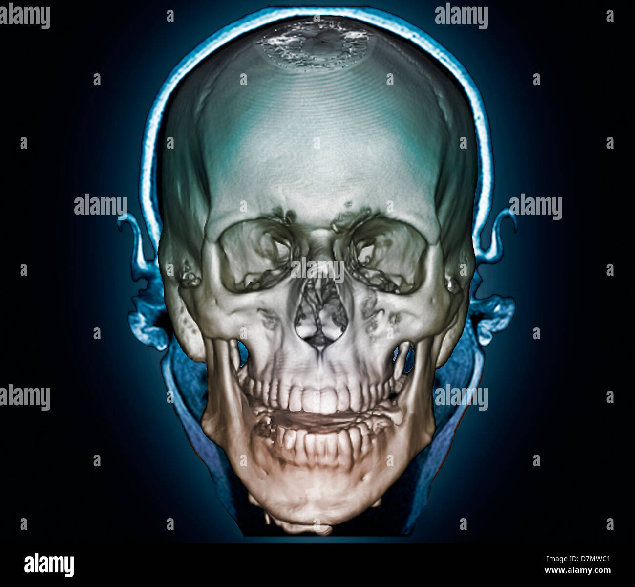 Crâne humain, 3D CT scan Photo Stock - Alamy