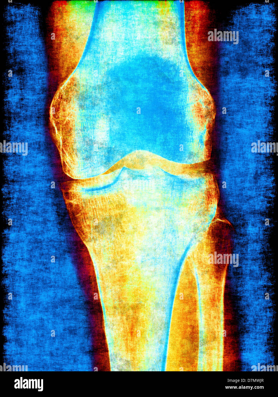 Articulation du Genou, x-ray, artwork Banque D'Images