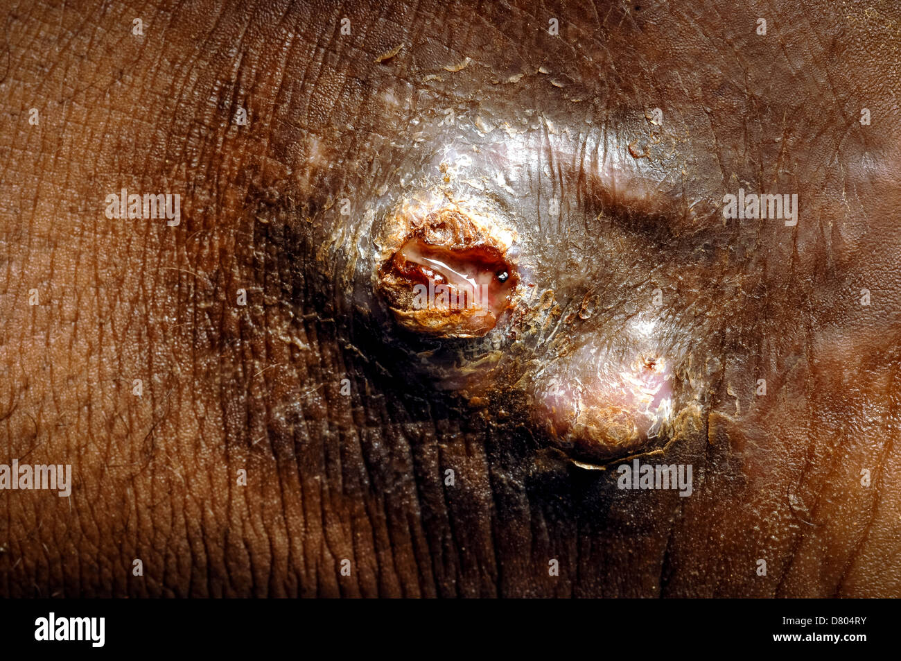 Close up of a guéri eumycetoma sur la cheville de l'homme de 20 ans. Banque D'Images