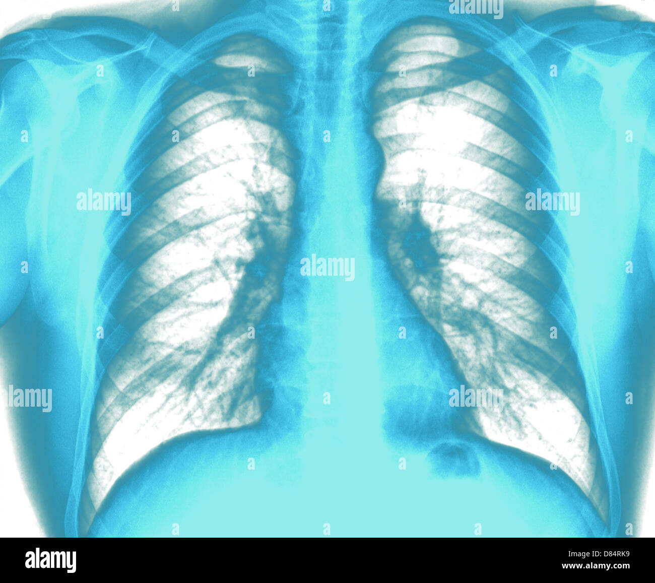 X-Ray Image poitrine en bonne santé Banque D'Images