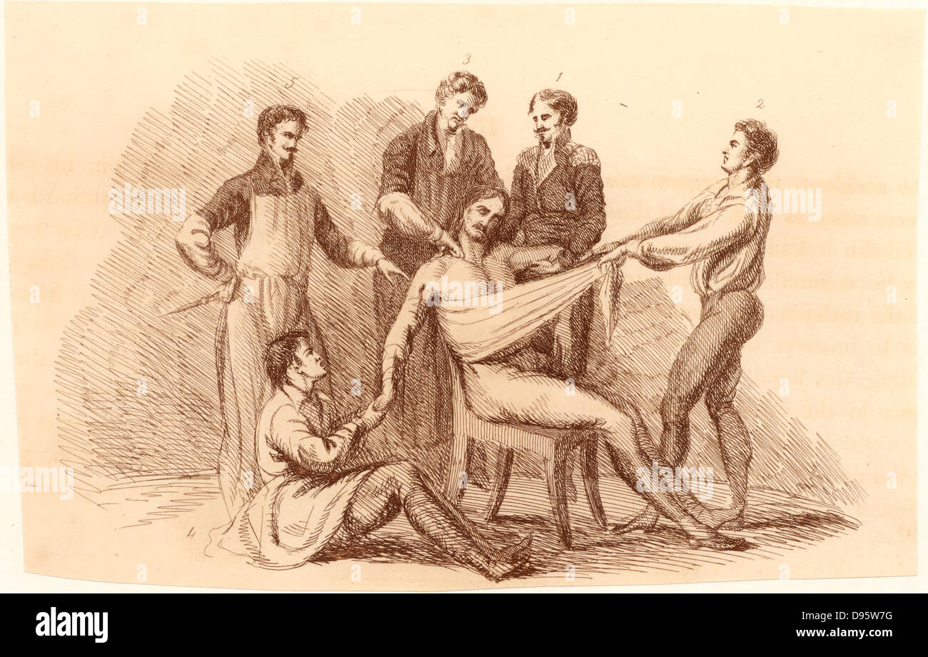 Chirurgien et ses assistants, avant l'introduction d'anesthésiques, prêt à effectuer une amputation à l'épaule. Chirurgien se trouve, à gauche, à côté de l'assistant-chirurgien (derrière le patient). Un assistant sur le terrain prend en charge le bras d'être enlevés, et les deux figures debout sur le support droit du patient. Commentaire de Bell sur cette opération était 'il exige et la rapidité de la décision ; et le couteau est d'être traité plus comme un sabre, d'un chirurgien de la scapel'. Gravure tirée de 'Illustrations des grandes opérations de chirurgie" par Charles Bell (Londres, 1821). Banque D'Images