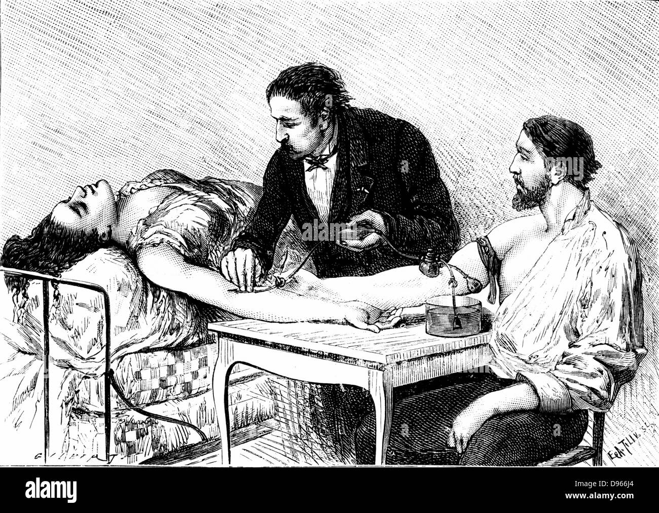 Dr Roussell de Genève femme donnant une transfusion de sang d'une bénévole, 7 février 1882. Après la naissance de jumeaux prématurés, en décembre 1881, le patient est devenu de plus en plus faible et la transfusion a été jugé comme dernier recours. Le 13 Février elle a été en train, et bien sur le chemin de la guérison. La gravure, Paris, 1882. Banque D'Images