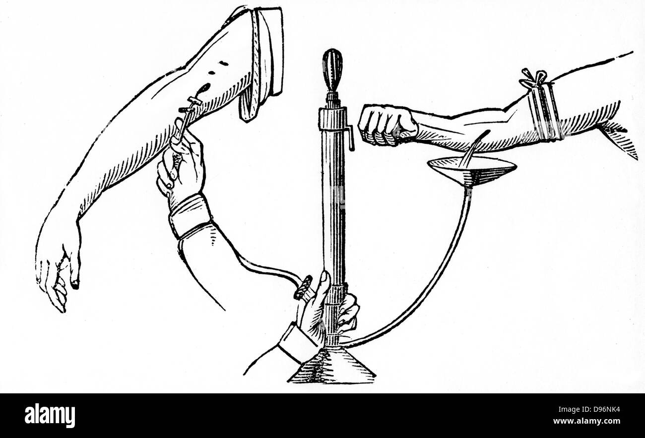 Personne à personne une transfusion de sang. Dans la méthode de lecture présenté ici, le sang du donneur est passé à travers un pompée et contraint à bras du destinataire via une canule. À partir de 'la Cyclopaedia britannique des arts et des Sciences", Charles Partington, 1833. Gravure sur bois. Banque D'Images