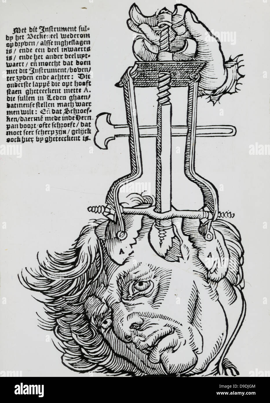 Trephination : ascenseur pour enlever des fragments de crâne brisé. Gravure sur bois à partir d'un livre sur la chirurgie de champ, 1593. Banque D'Images