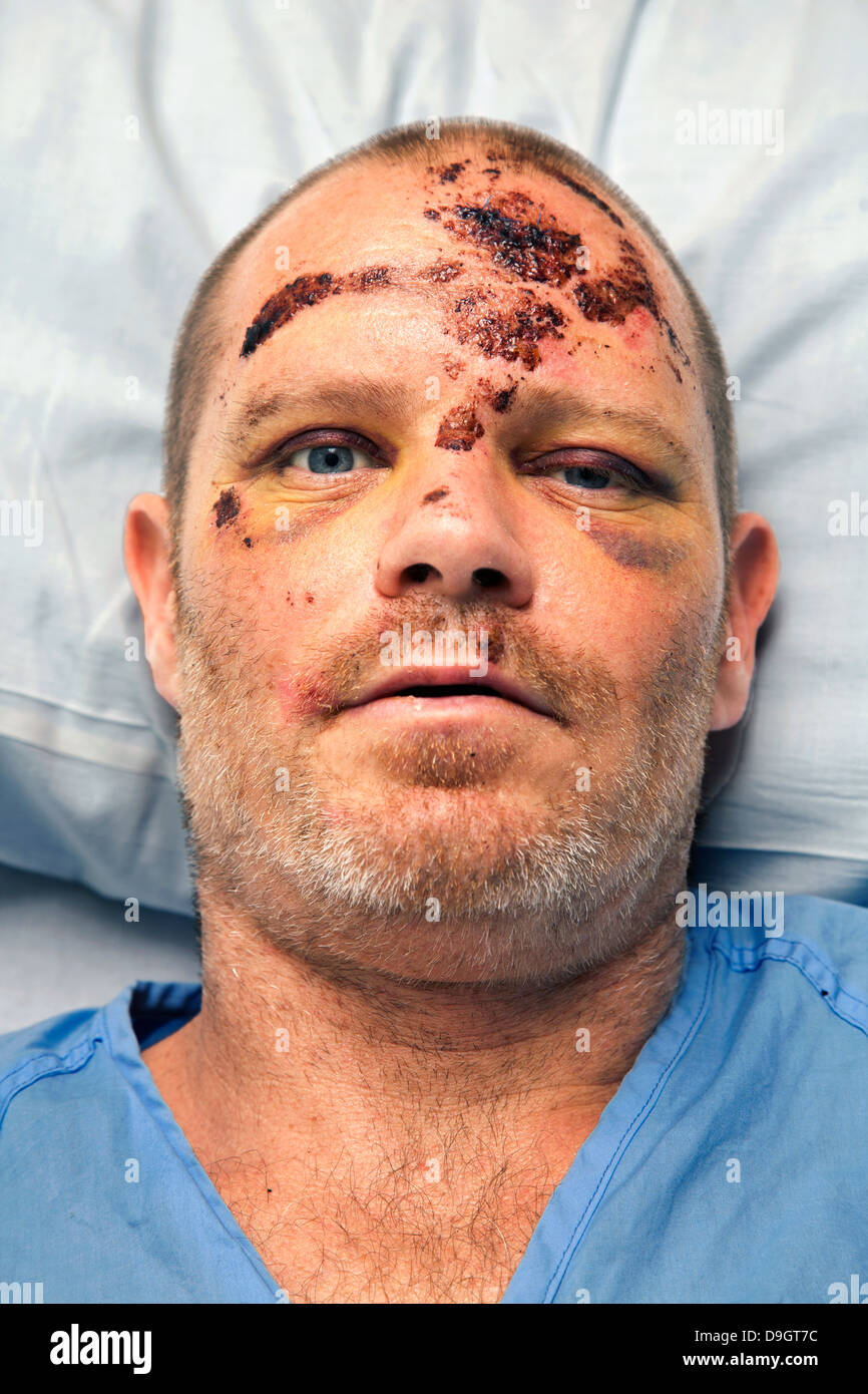44 ans, homme, et à l'hôpital avec fracture du crâne. Banque D'Images