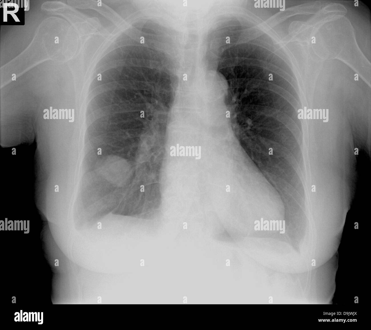 La radiographie du thorax par une tumeur sur le côté droit Photo Stock